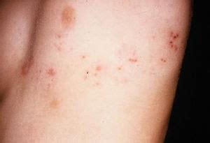 This is the same virus that causes chickenpox. Anfangsstadium Gurtelrose Symptome
