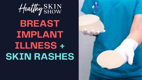 Can Breast Implant Illness Trigger Skin Rashes Dr Anthony Youn Youtube
