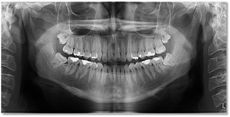 Nasal cavity / diagnostic imaging*. Radiographic Quality Evaluation: Ideal Pantomograph - Dr ...