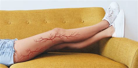 How To Get Rid Of Spider Veins And Varicose Veins Self
