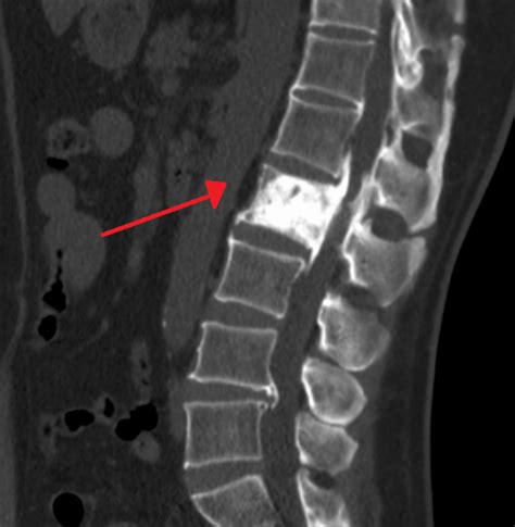 Paget's disease occurs when your bone cells don't function. Paget's Disease of Bone | Pictures, Causes, Signs and ...