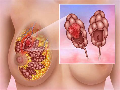 Unlike inflammatory breast cancer, however, mastitis usually causes a fever and is easily treated with antibiotics. Breast Cancer Symptoms I 9 Early Warning Signs Of Breast ...