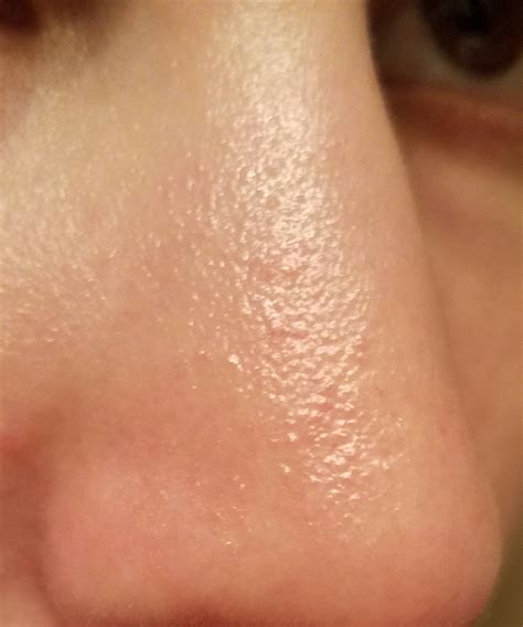 Textured Bumps On My Nose Appeared Yesterday General Acne Discussion