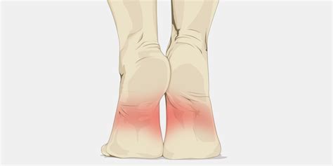 Pain In Arch Of Foot The Complete Injury Guide Vive Health