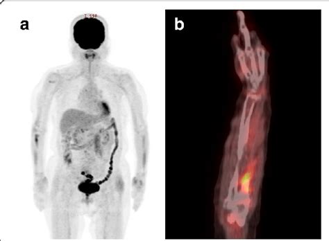 Pet Ct Imaging A Whole Body Scan Did Not Show Any Distant Metastasis