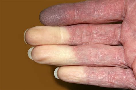 What Do You Know About Raynauds Disease The Island News Beaufort Sc