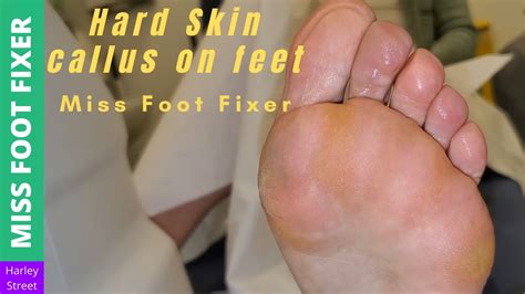 Hard Skin Callus On Feet Removal Miss Foot Fixer Youtube