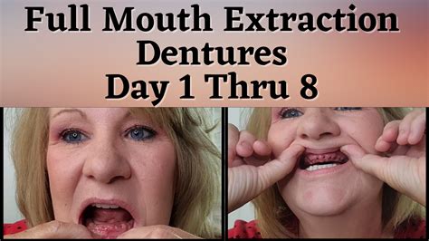 Dentures Day 1 And Full Mouth Extraction In 2023 Dentures Mouth Full