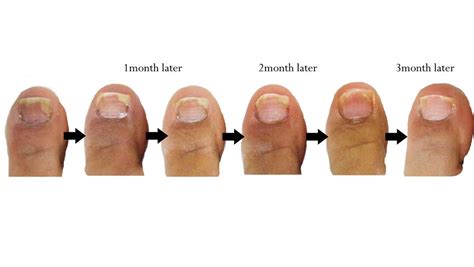 Nail Infection Fungal Causes Symptoms Treatment Nail Infection
