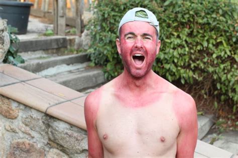 Man With Funny Sunburn Stock Photos Pictures And Royalty Free Images