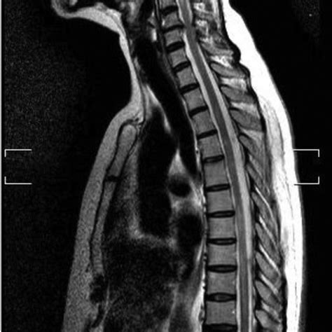 Thoracic Spinal Cord Mri T Weighted Sequence Revealing A Hyperintense Download Scientific