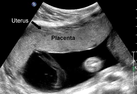 Prenatal Diagnosis Of Morbidly Adherent Placenta International