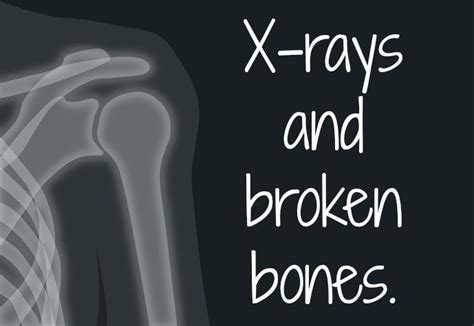 Life As Kim X Rays And Broken Bones Blogtober18