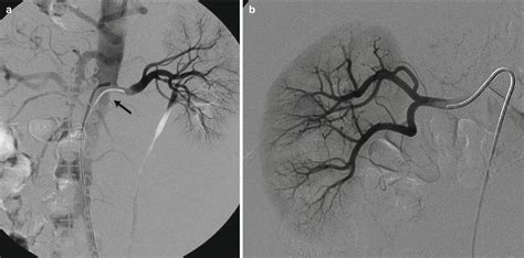 Angiography And Vascular Interventional Radiology Radiology Key