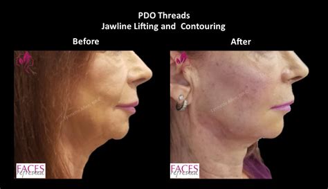 Pdo Thread Lift Fix Sagging Jowls Non Surgical Face L