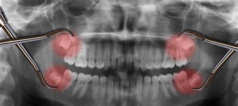 Co to są zęby zatrzymane Jakie są przyczyny i objawy jak leczyć