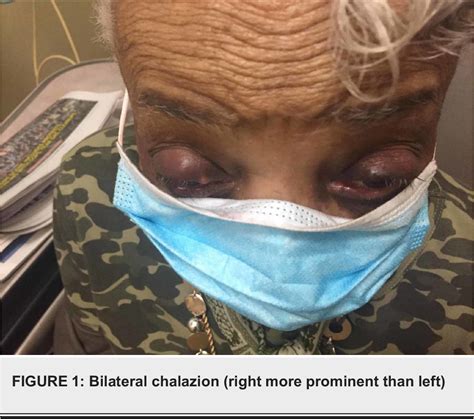 Figure 1 From A Case Report On Bortezomib Induced Bilateral Chalazion