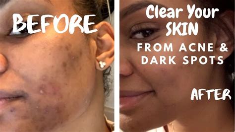 How I Cleared My Acne Dark Spots And Hyperpigmentation Youtube