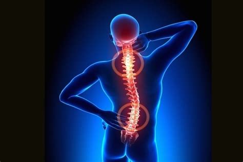 Spinal Osteoarthritis What Is It Symptoms And Treatment