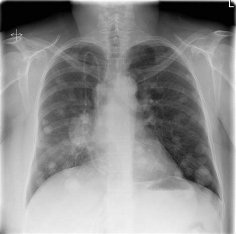The holes in the lungs present the clinical picture of a lung emphysema with a chronic shortness note: Canon-ball pulmonary mets from breast cancer | Image ...