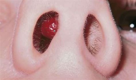 This acne is considered painful and may also form bumps on your nose which is also a result of an inflamed cyst. Lump in Nose, Pimple, Won't Go Away, Painful, Red, Swollen ...