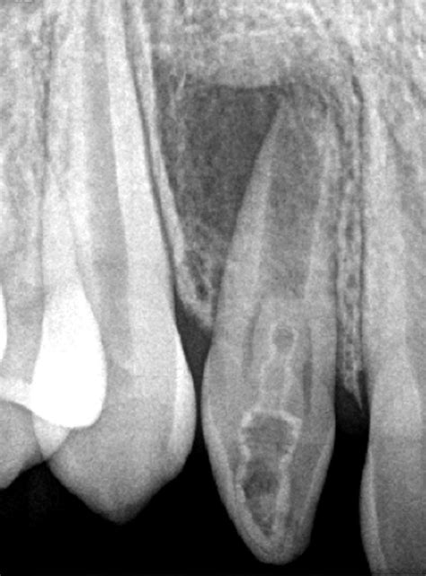 Maxillary Lateral Incisor With Dens In Dente Root Canal Specialty Associates