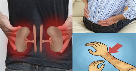 Early Dangerous Symptoms Of Kidney Failure You Probably Didnt Know