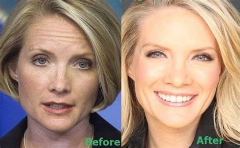 Dana Perino Plastic Surgery Facelift Nose Job Botox