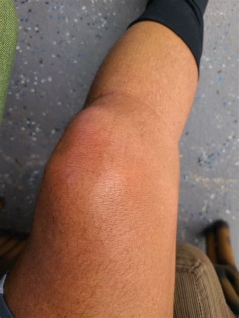 Swelling Of Fluid Behind Knee