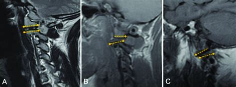 T2 Weighted Mri Of The C1 C2 Facet Joint In The Sagittal Plane A