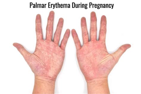 Palmar Erythema During Pregnancy Causes Symptoms And Treatment