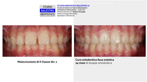 Studio Dentistico Balestro Malocclusione Di II Classe Div 1 Con Morso