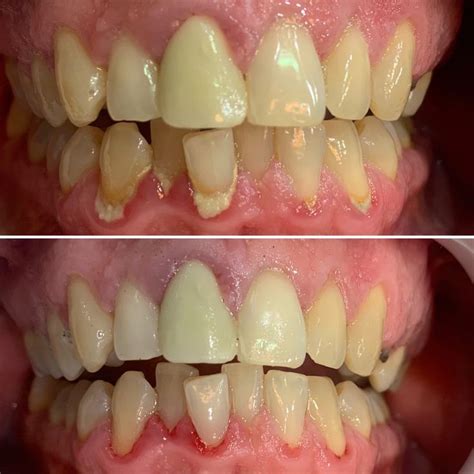 Antes y después de una limpieza Limpieza dental Limpieza