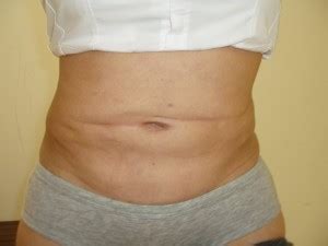 A fibrose quística (fq), cujo o nome deriva do aspecto quístico e fibroso do pâncreas, é uma doença causada por alterações genéticas. Meus, Lindos e Pagos! » Arquivos » O que é fibrose