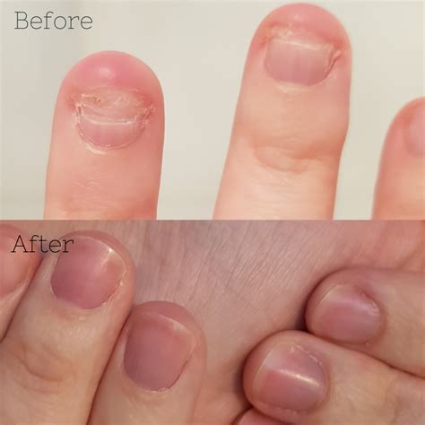 5 Ways To Stop Biting Your Nails Make Nails Grow How To Grow Nails
