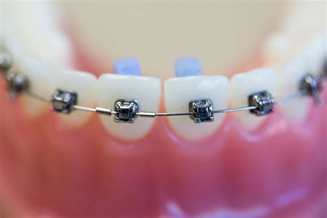 The Damon Braces System Owen Orthdontics