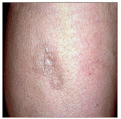 Subcutaneous Panniculitis Like T Cell Lymphoma Basicmedical Key