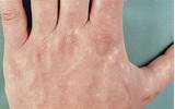 Well, we understand that it would be irritating and annoying to. Constitutive Speckled Vascular Mottling of the Skin ...