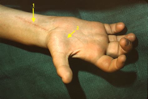 Median Nerve Laceration Hand Surgery Resource