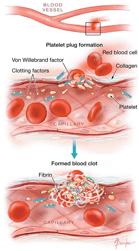 What is a blood clot? Bleeding Disorders | Coagulation Disorders | JAMA | The ...