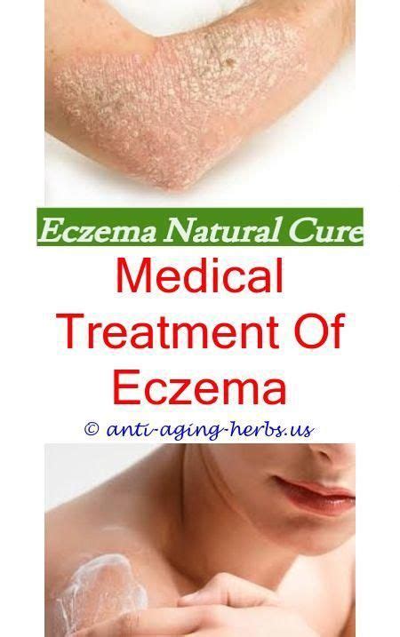 Pin On Eczema Cure Treatment