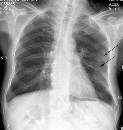 X Ray Image A Chest Radiograph Showed Fractures Of The Left Sixth And