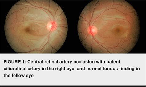 Figure 1 From Central Retinal Artery Occlusion With Sparing Of
