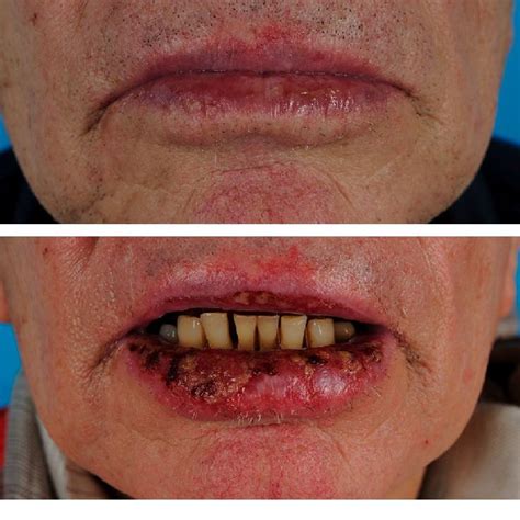 80 Year Old Lady With Actinic Cheilitis Of The Lower Lip Before A And