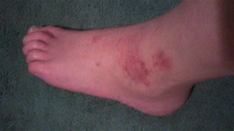 Left Ankle Showing The Itchy Rash That Follows The Swelling That I Can