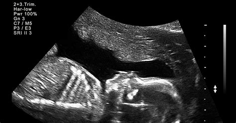 What To Expect At Your 20 Week Ultrasound Appointment Todays Parent