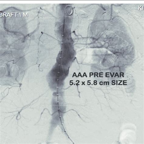 Stent Graft Seen In Situ Post Evar Procedure Angiogram Showing