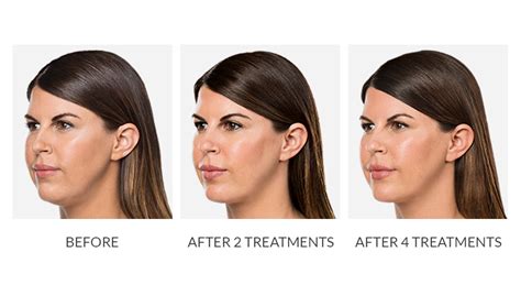 Kybella® Before And After Photos Glendale Dermatology