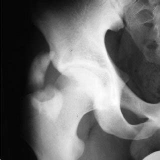 (PDF) Heterotopic ossification following surgical ...