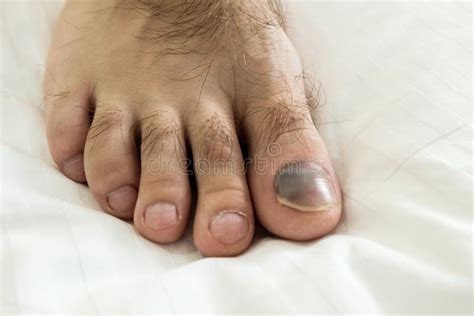 Male Foot With Black Injured Toe On A White Bed Sheet Blood Hematoma
